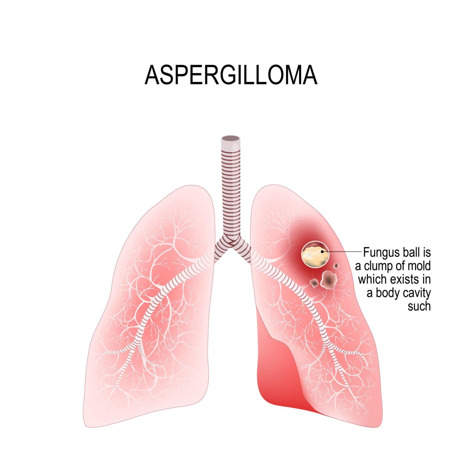 Aspergilloma (ağciyərlərdə küf topu)