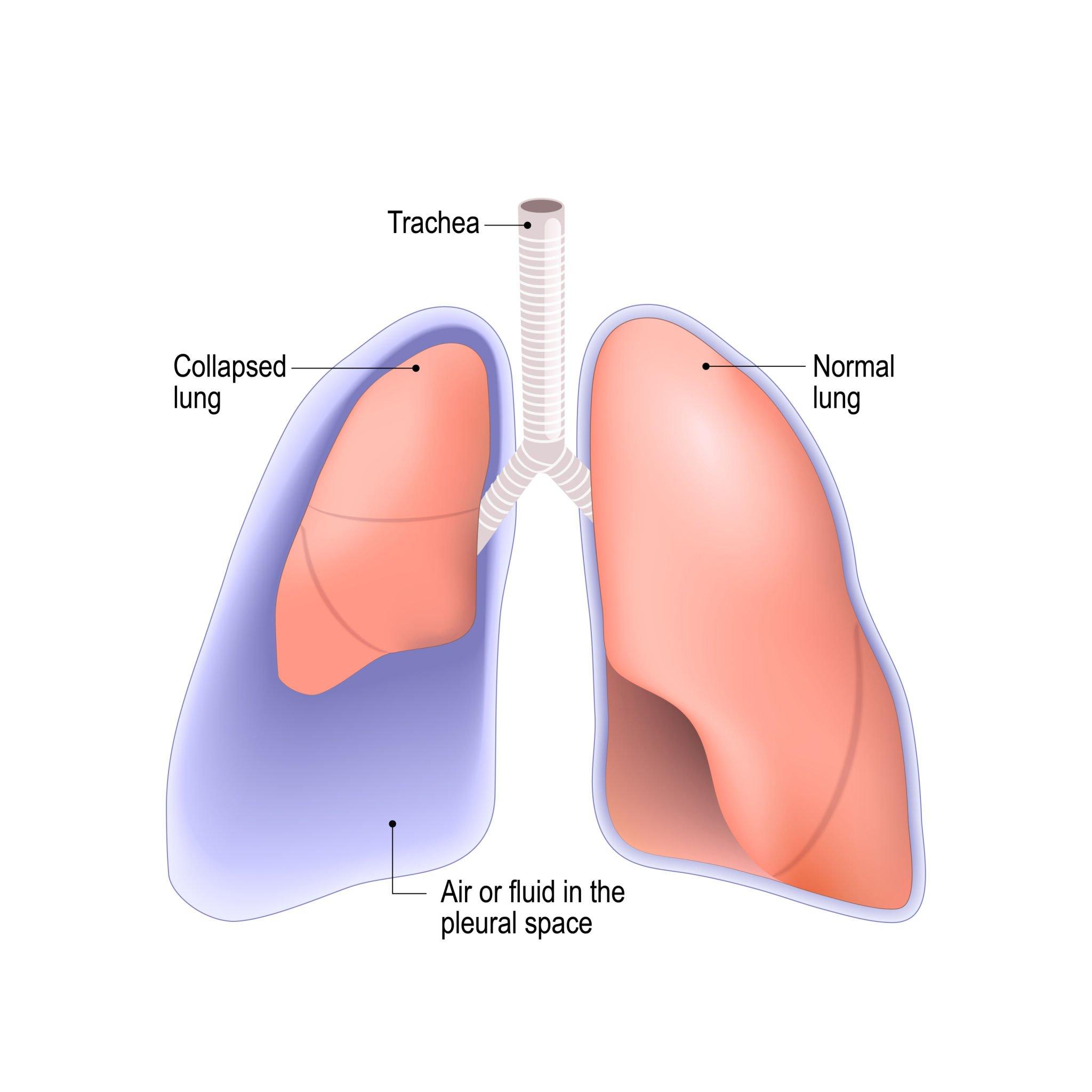 collapsed lung. pneumothorax, or pleural effusion, or empyema