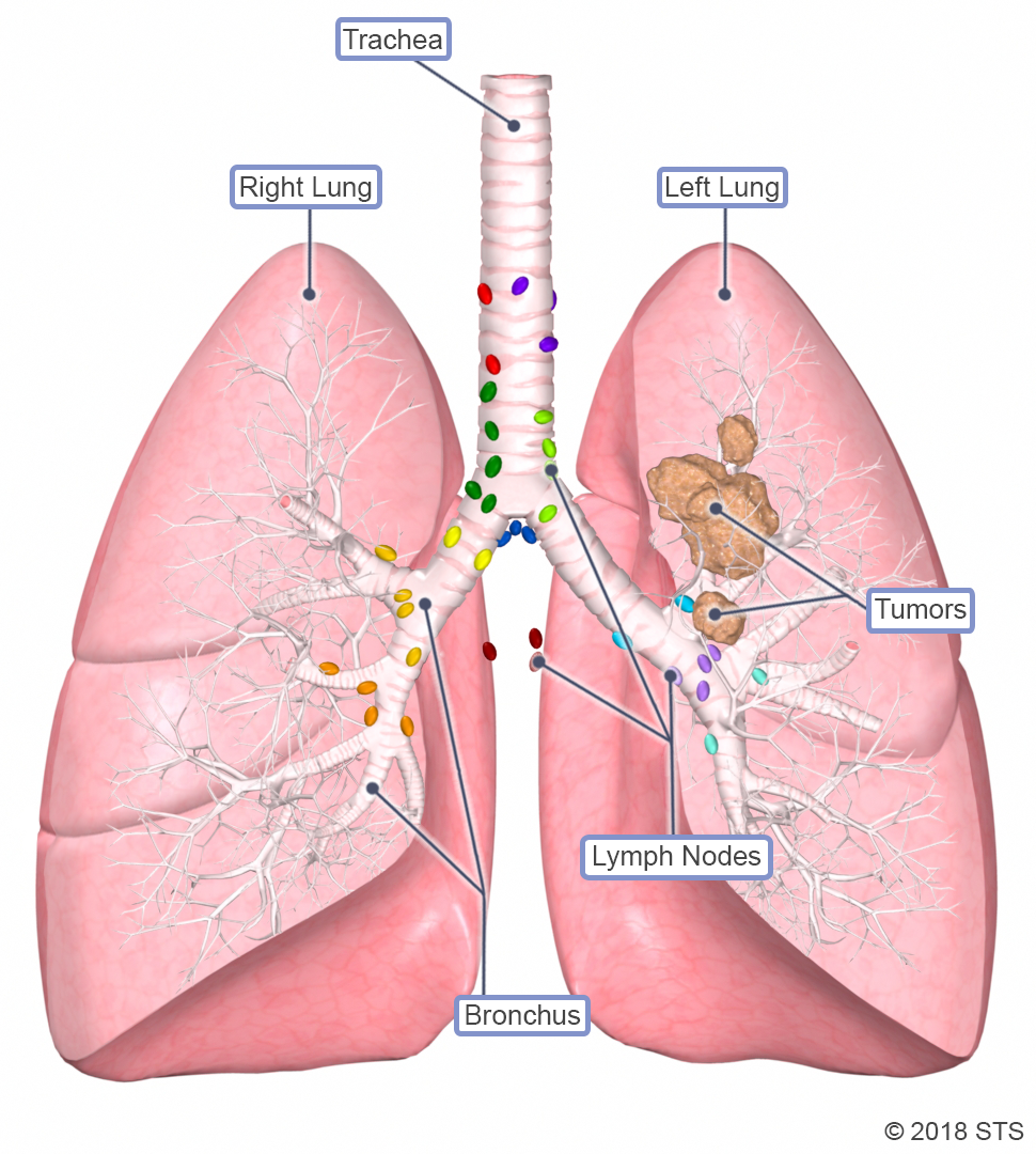 lung cancer