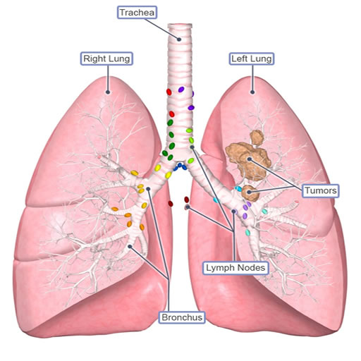 lung cancer