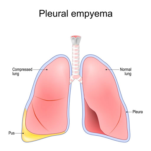 pleural empyema