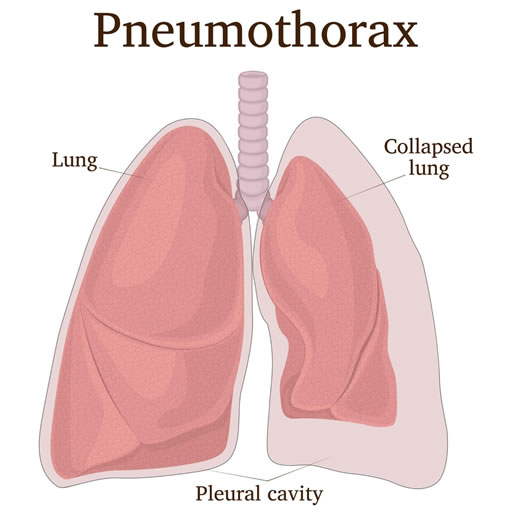 pneumothorax