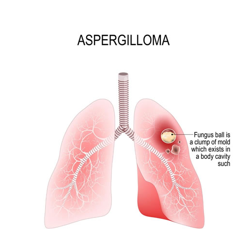 aspergilloma