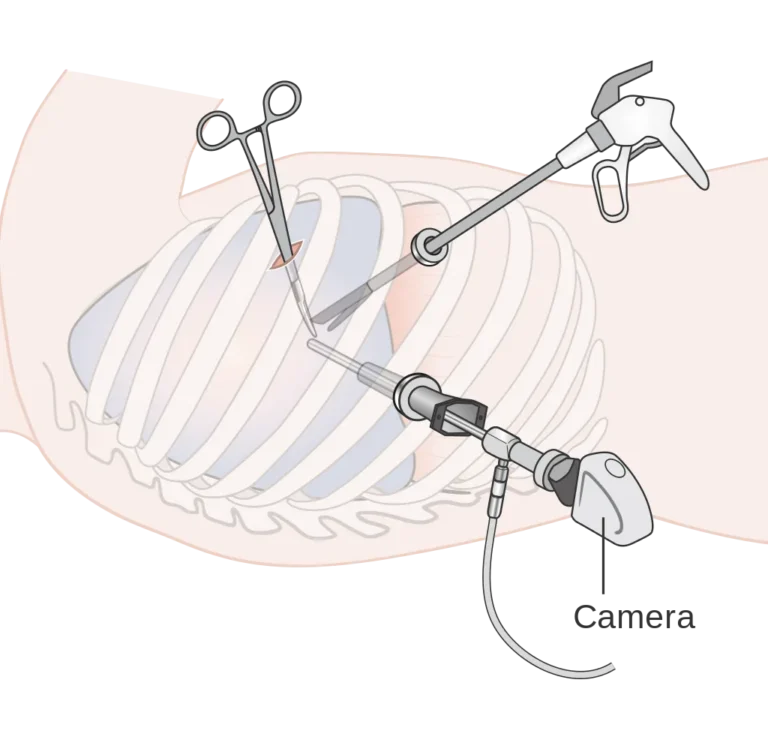 VATS (Keyhole) Surgery – diagram