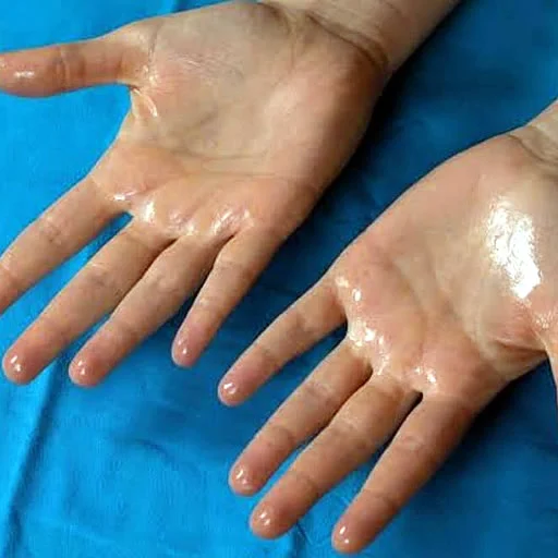 Surgery for Hyperhidrosis