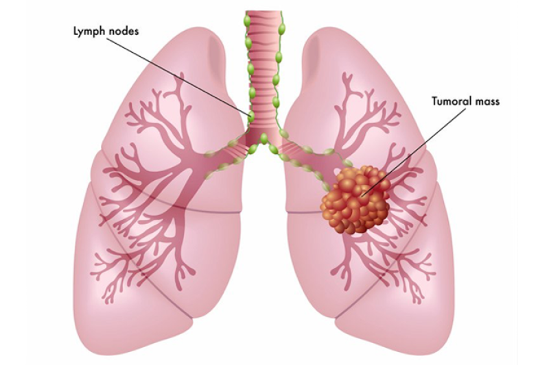 LungCancer