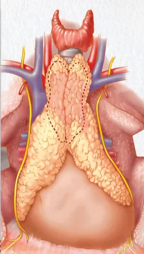 Myasthenia Gravis & Thymoma