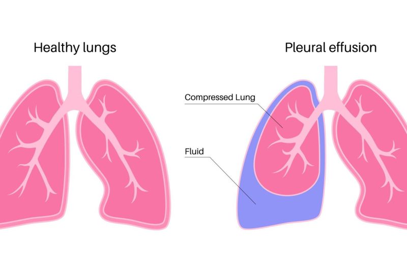 pleural effusion poster